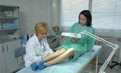 jak léčit křečové žíly na nohou