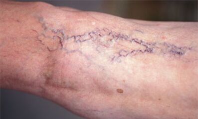 metody léčby křečových žil na nohou