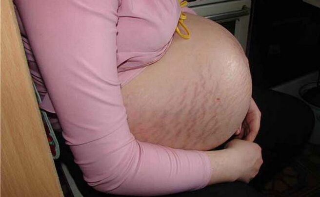 příčiny křečových žil během těhotenství