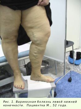 Křečové žíly se musí léčit, aby se proces zastavil