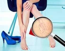 Příznaky závisí na povaze a stádiu křečových žil