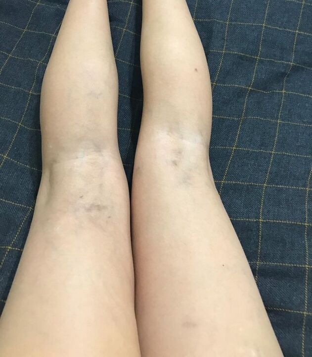 projevy křečových žil na nohou